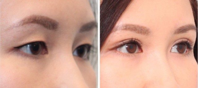 Азиатский разрез глаз: операция, блефаропластика, как изменить разрез глаз