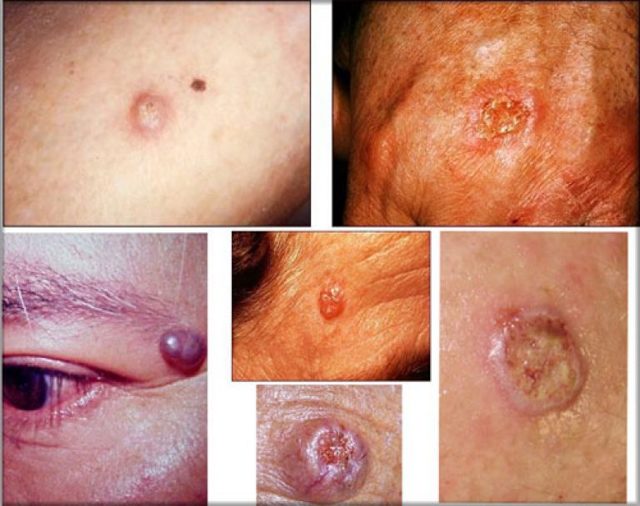 Базалиома лица, кожи носа: стадии развития, характерные симптомы, методы терапии