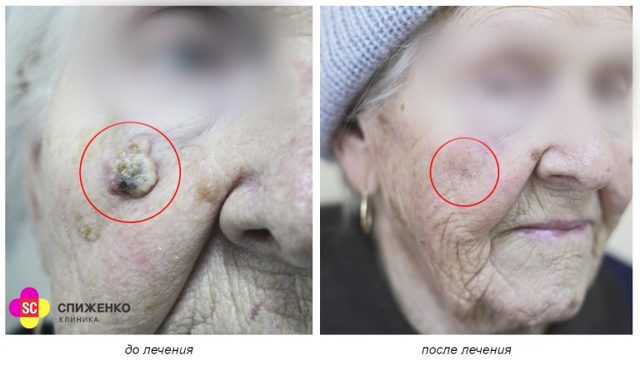 Базалиома лица, кожи носа: стадии развития, характерные симптомы, методы терапии
