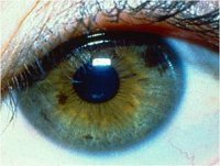 Белая точка, пятно на радужке глаза: причины появления, методы обследования и особенности лечения