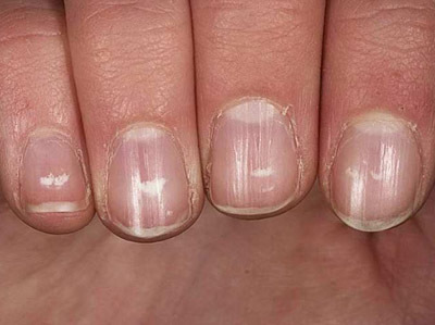 Белые пятна на ногтях: причины появления, особенности обследования, лечебные и профилактические мероприятия