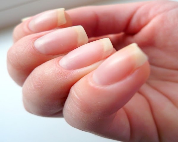 Белые пятна на ногтях: причины появления, особенности обследования, лечебные и профилактические мероприятия