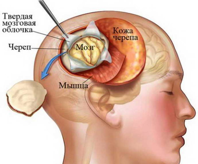Биопсия головного мозга: разновидности обследования, причины назначения, процесс проведения, возможные последствия