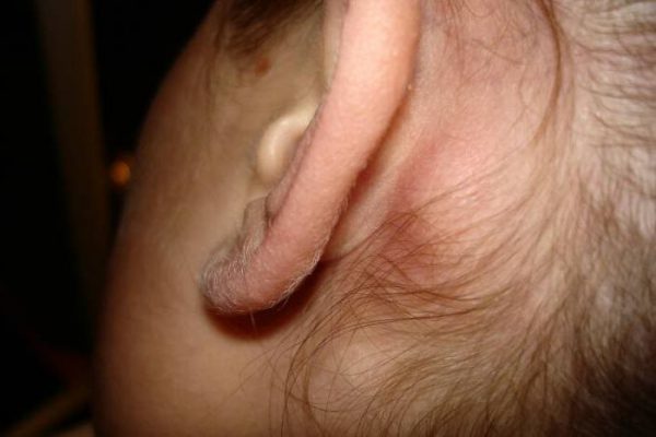 Боль и заложенность в ушах, что делать: о чем говорят симптомы?