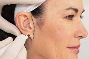 Большие, лопоухие уши – операция, исправление формы ушей, отопластика ушей