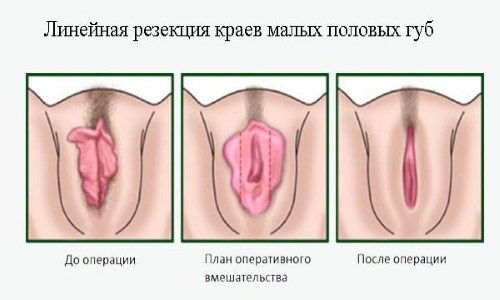 Большие половые губы меньше малых: лабиопластика для уменьшения малых половых губ