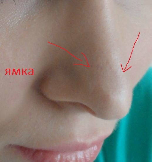 Большой нос – пластика носа, операция, осложнения после ринопластики, подготовка