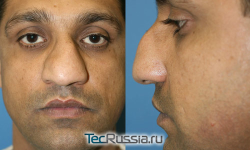 Большой нос – пластика носа, операция, осложнения после ринопластики, подготовка