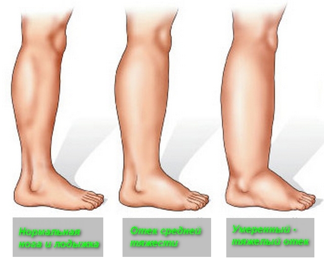 Боль в ноге от колена до стопы: основные причины, методы обследования, лечебные и профилактические мероприятия