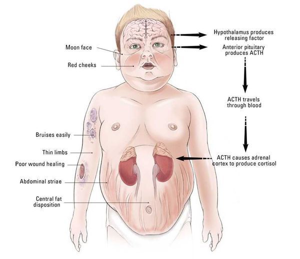 Болезнь Иценко-Кушинга: факторы риска развития, характерные симптомы, методы обследования и лечения