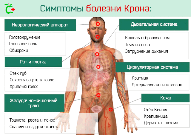 Болезнь крона: симптомы, лечение, диагностика болезни крона толстой кишки и тонкого кишечника.