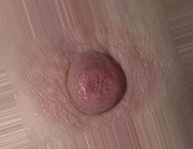 Болезнь Педжета (рак соска молочной железы): симптомы на начальной стадии