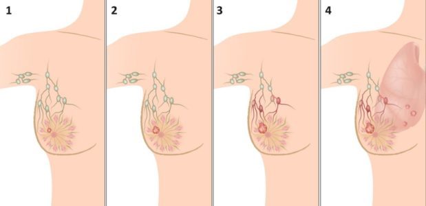 Болезнь Педжета (рак соска молочной железы): симптомы на начальной стадии