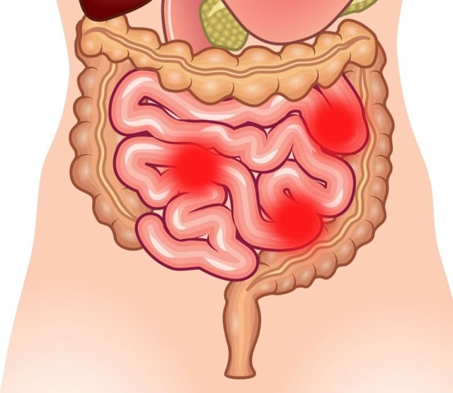 Боли в кишечнике: провоцирующие факторы и классификация, методы обследования и лечения, правила питания