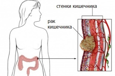 Боли в кишечнике: провоцирующие факторы и классификация, методы обследования и лечения, правила питания