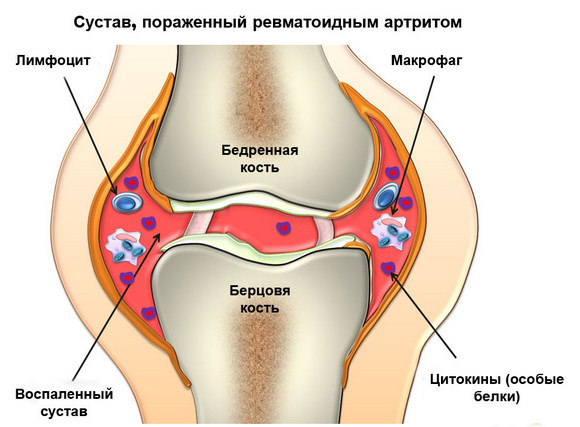 Болит колено: провоцирующие факторы, клиническая картина, выбор врача, принципы лечения