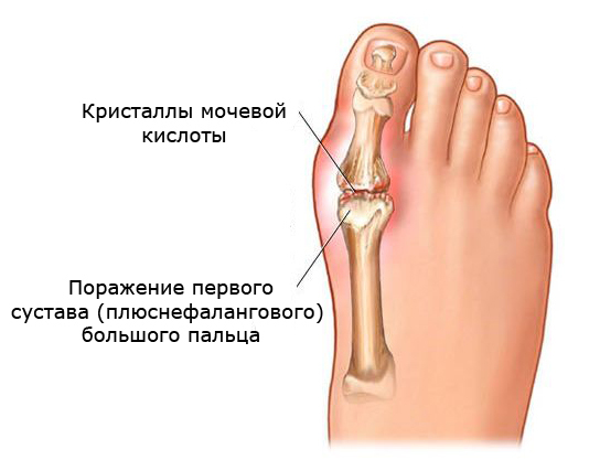 Болит сустав большого пальца на ноге: возможные причины, консервативные и хирургические методы лечения
