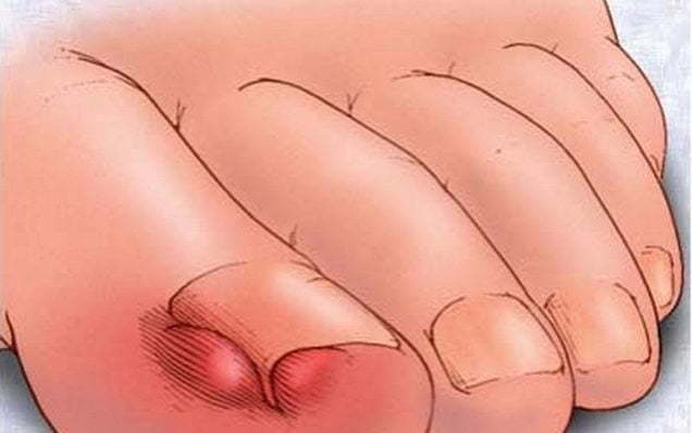 Болит сустав большого пальца на ноге: возможные причины, консервативные и хирургические методы лечения