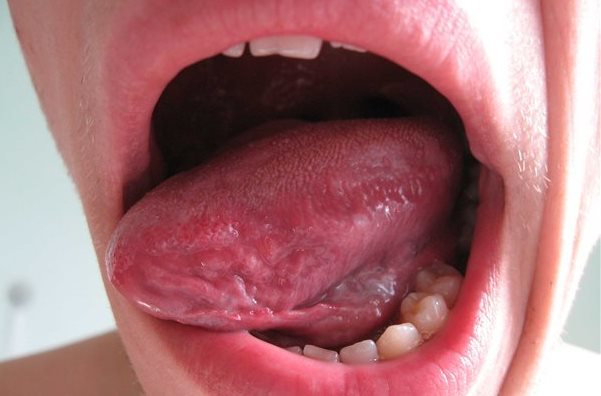 Болит язык сбоку, посередине, как будет обжегся: причины дискомфорта, медикаменты и народные способы лечения