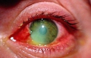 Болят глаза после сварки: причины недомогания, аптечные и народные средства лечения
