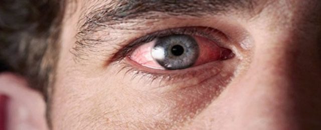 Болят глаза после сварки: причины недомогания, аптечные и народные средства лечения