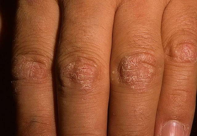 Болят пальцы рук: возможные заболевания, клиническая картина, диагностика и принципы лечения
