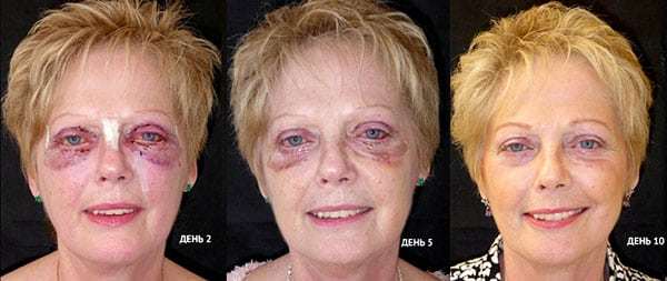 Ботокс для лица: фото до и после, противопоказания для уколов красоты, побочный эффект