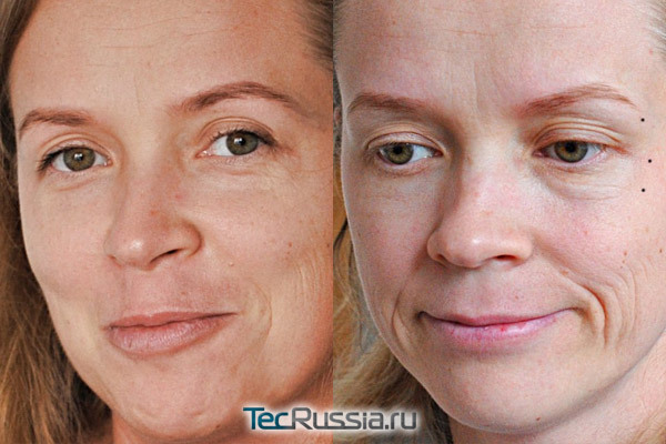 Ботокс для лица: фото до и после, противопоказания для уколов красоты, побочный эффект