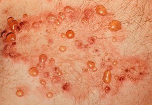 Буллезный дерматит: что это, симптомы и лечение в домашних условиях