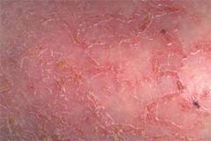 Буллезный дерматит: что это, симптомы и лечение в домашних условиях