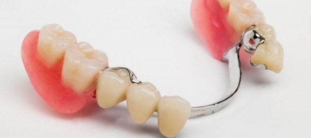 Бюгельные протезы для зубов: как правильно выбрать на верхнюю и нижнюю челюсть