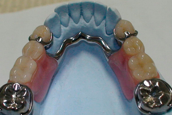Бюгельные протезы для зубов: как правильно выбрать на верхнюю и нижнюю челюсть