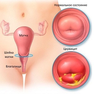 Цервицит шейки матки: причины заболевания, его симптомы, методы лечения