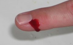 Чем обработать фалангу пальца, если оторвало кусок кожи?