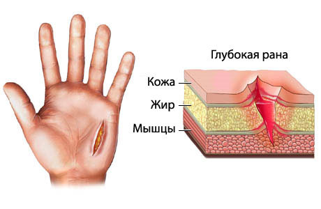 Чем обработать фалангу пальца, если оторвало кусок кожи?