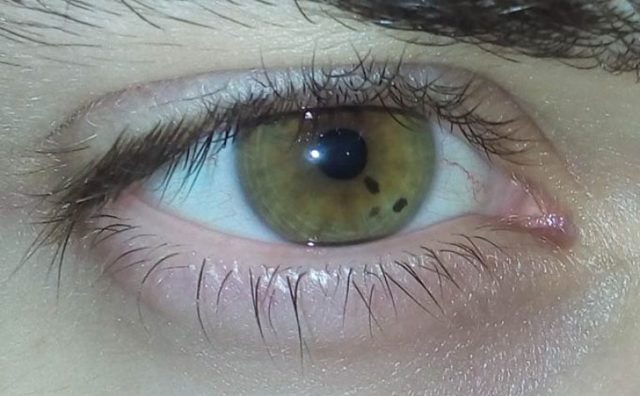 Черная точка в глазу на роговице, передвигается с взглядом – что это за болезнь?