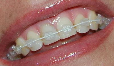 Что лучше зубная пластика или брекеты для детей: инструкция к установке