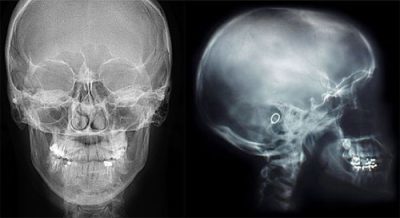 Что показывает и как делают рентген головы при сотрясении у ребенка и взрослого