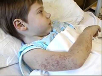 Что такое аллергический васкулит и методы его лечения у детей и взрослых