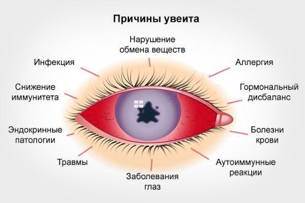 Что такое увеит глаза: как проявляется передний и задний увеальный тракт