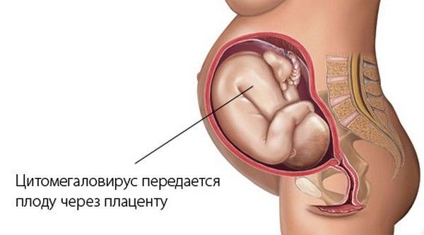 Цитомегаловирусная инфекция (ЦМВИ): осложнения при беременности, почему проявляется и как диагностируется?