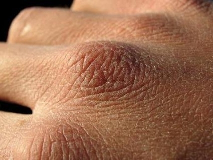 Цыпки на руках – причины появления, способы лечения и профилактики, фото патологии