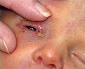 Дакриоцистит у новорожденных: причины заболевания, типичные симптомы, принципы лечения и меры предосторожности