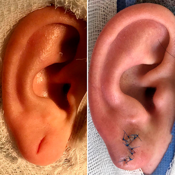 Деформация ушных раковин: отличия врожденной и приобретенной формы, лечение отопластикой