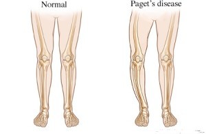 Деформирующий остеит костей или болезнь Педжета: причины развития, основные симптомы, диагностика и принципы лечения