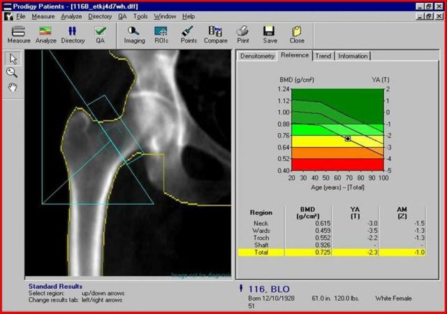 Денситометрия костей: суть процедуры, правила подготовки, особенности проведения диагностики