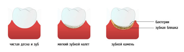 Дентамет гель стоматологический: состав, инструкция по применению, аналоги