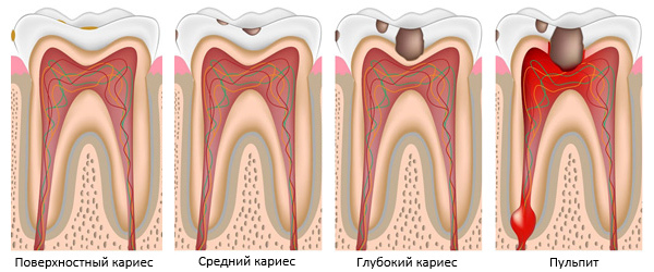 Дентамет гель стоматологический: состав, инструкция по применению, аналоги