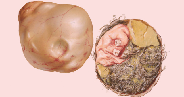 Дермоидная киста, тератома яичника: причины развития, основные симптомы, методы удаления и возможные осложнения