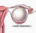 Дермоидная киста, тератома яичника: причины развития, основные симптомы, методы удаления и возможные осложнения
